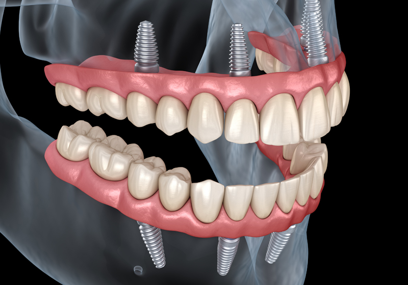 インプラントオーバー義歯