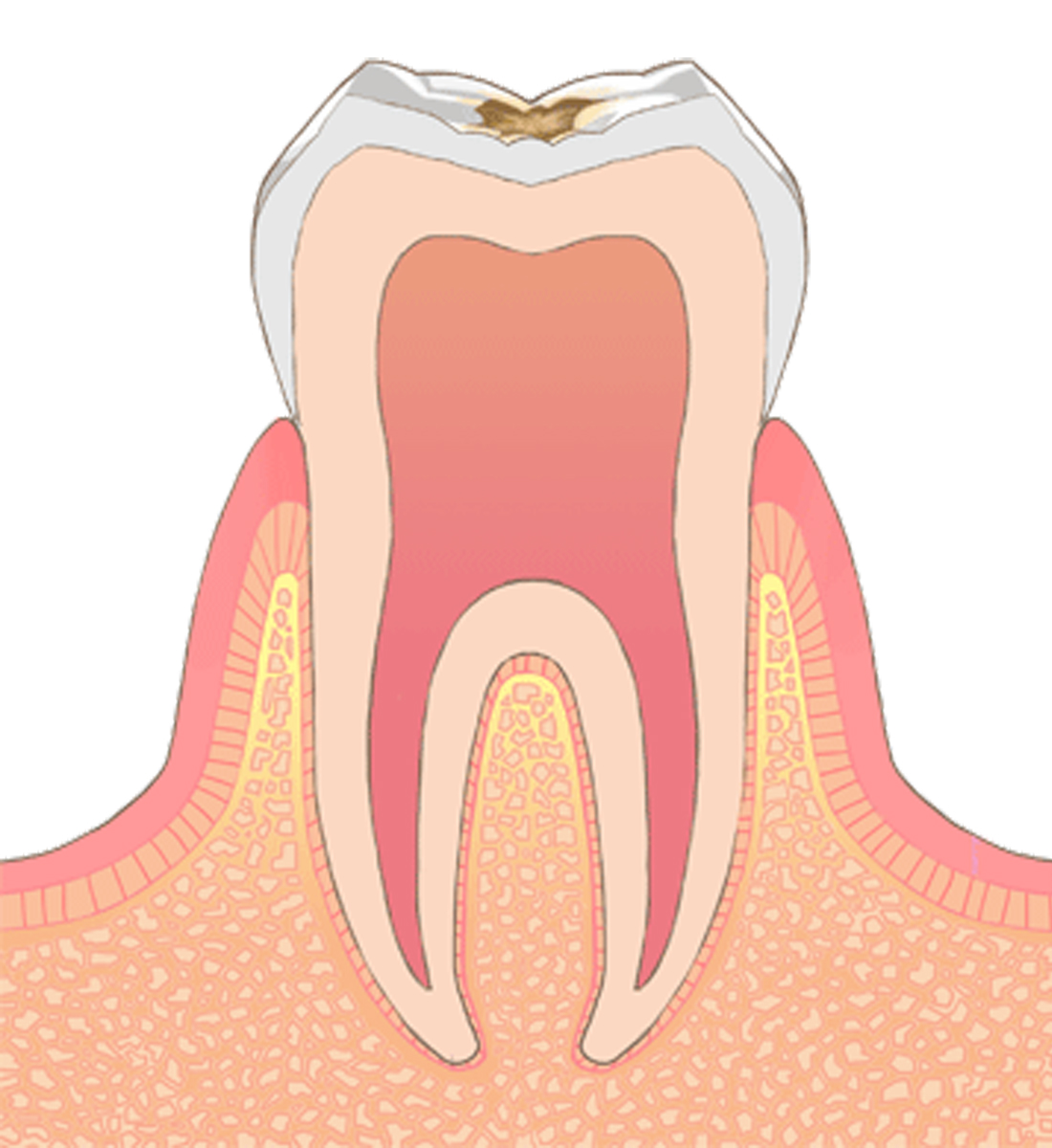 C1→虫歯の中期状態