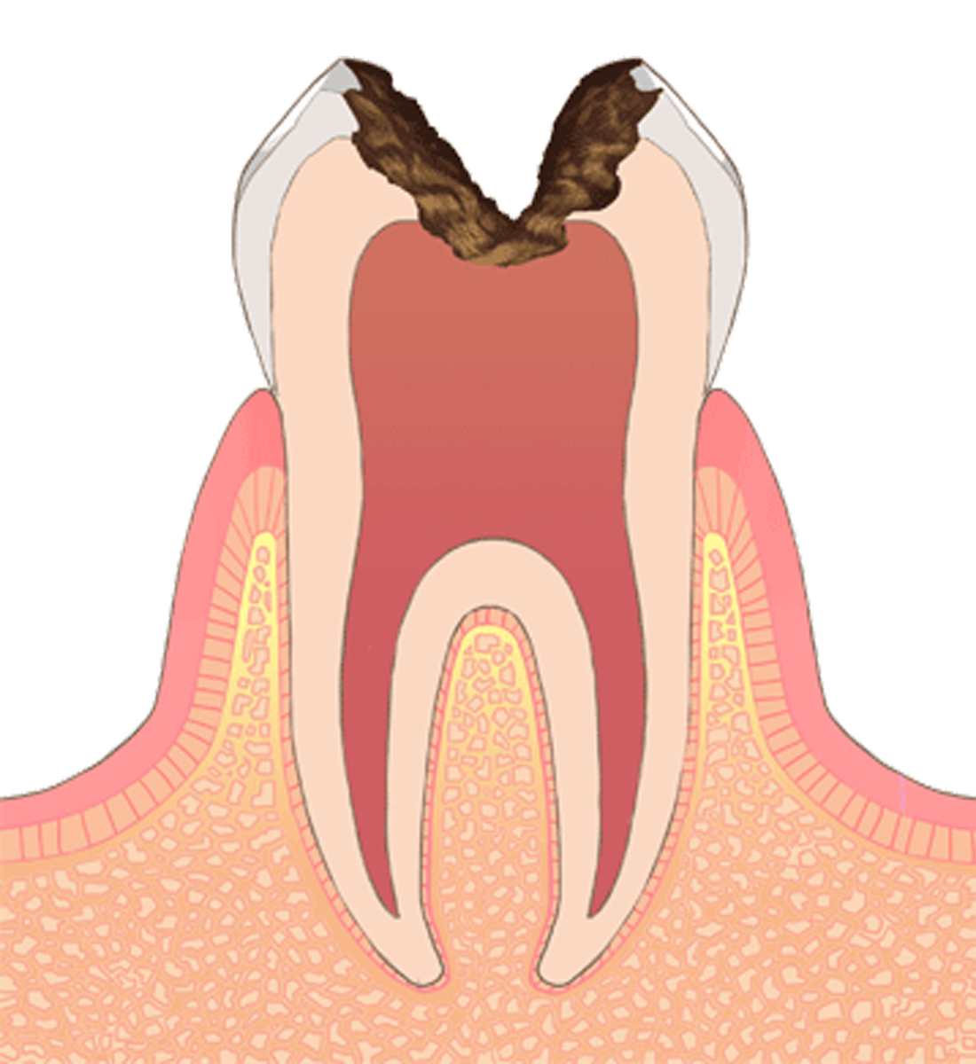 C3→虫歯の後期状態（後期）