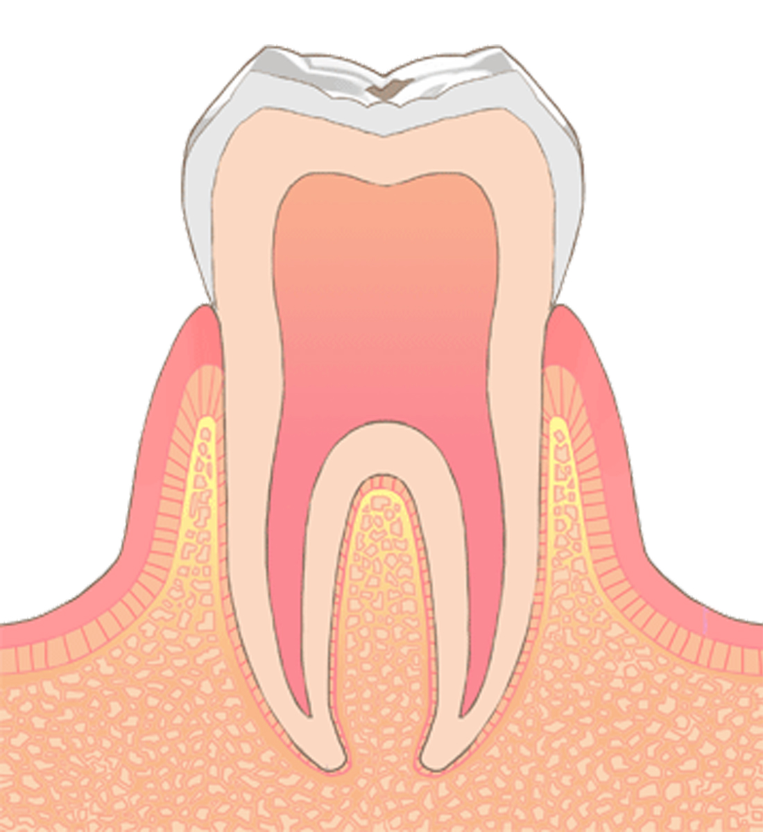 C0→虫歯の初期状態