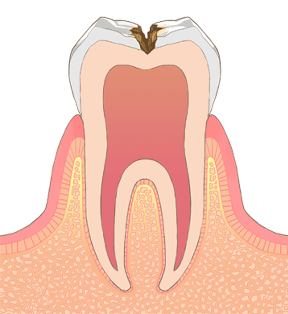 C2→虫歯の後期状態（初期）