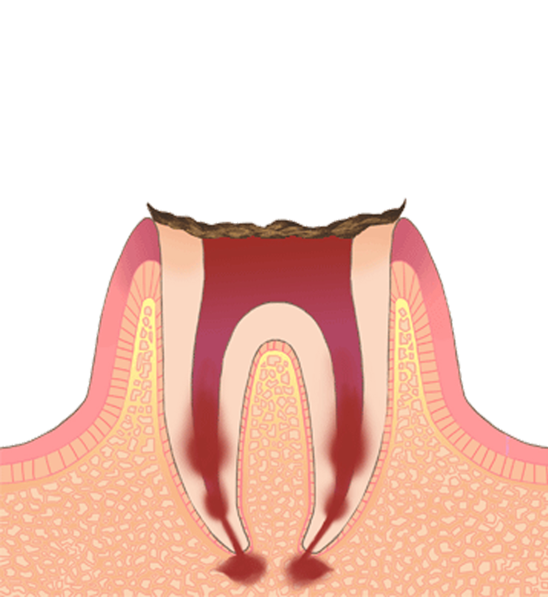 C4→虫歯の末期状態